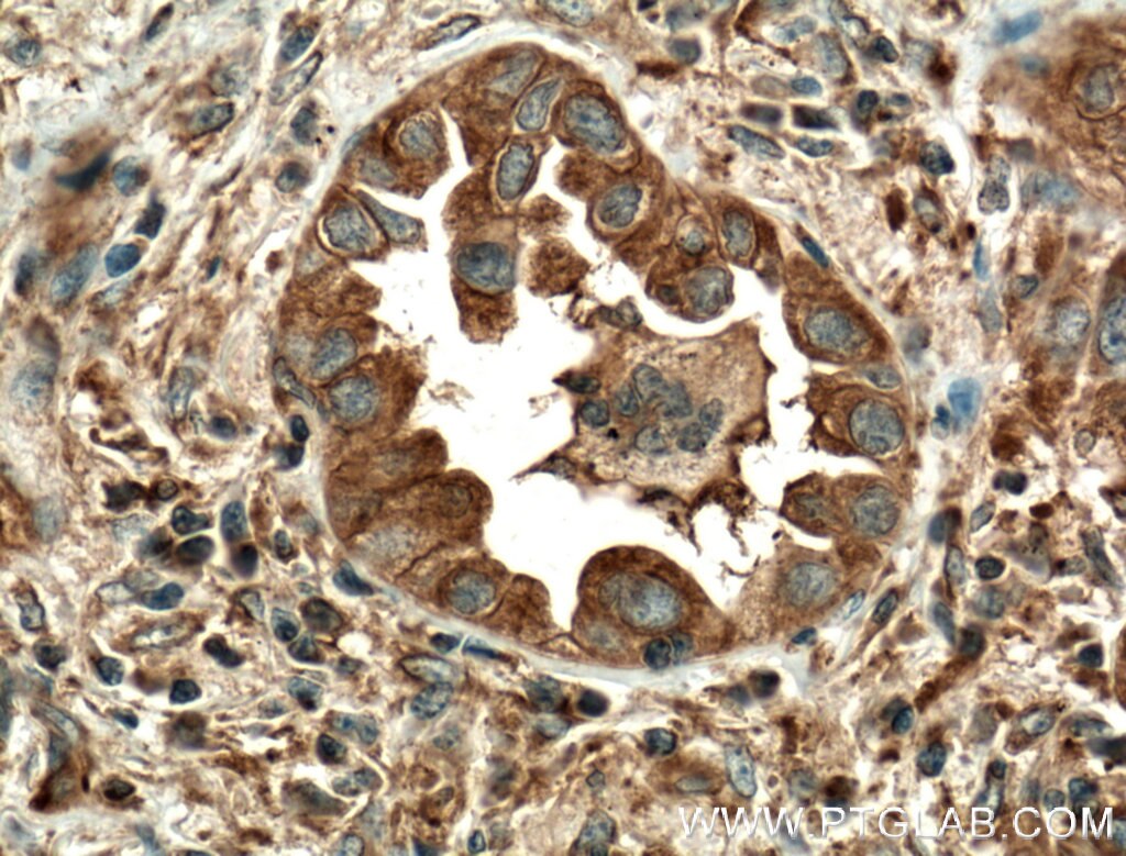 Immunohistochemistry (IHC) staining of human lung cancer tissue using MVP/LRP Polyclonal antibody (16478-1-AP)