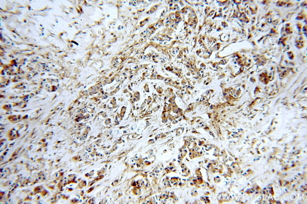 Immunohistochemistry (IHC) staining of human breast cancer tissue using MVP/LRP Polyclonal antibody (16478-1-AP)