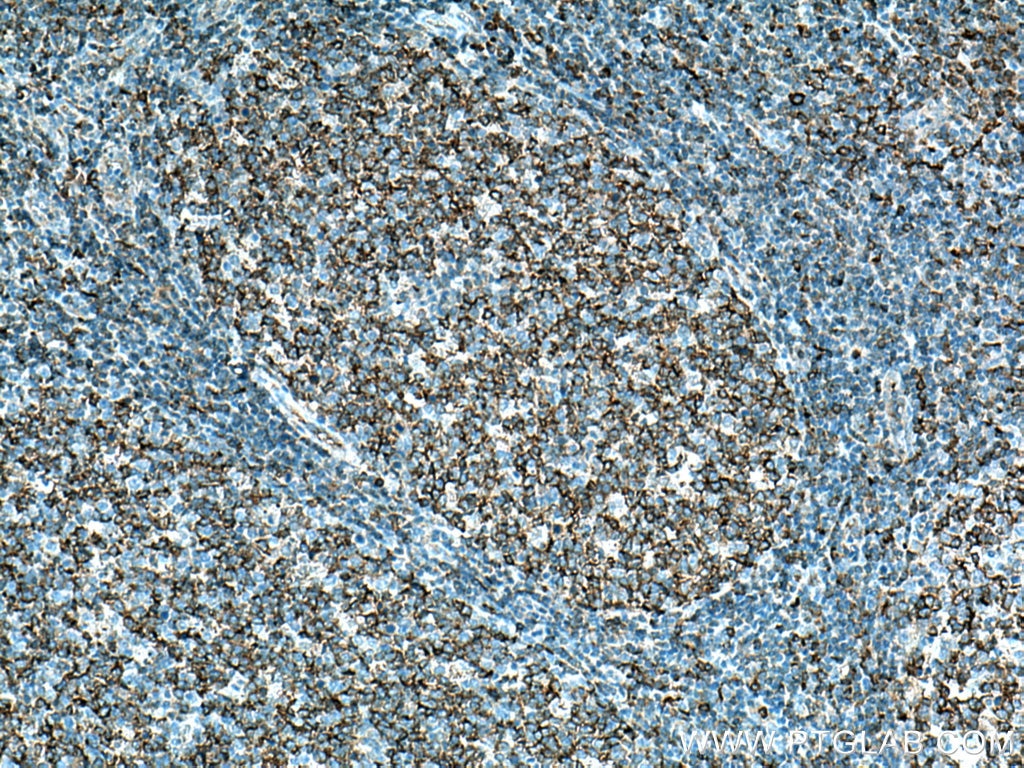 Immunohistochemistry (IHC) staining of human tonsillitis tissue using MX1 Polyclonal antibody (13750-1-AP)