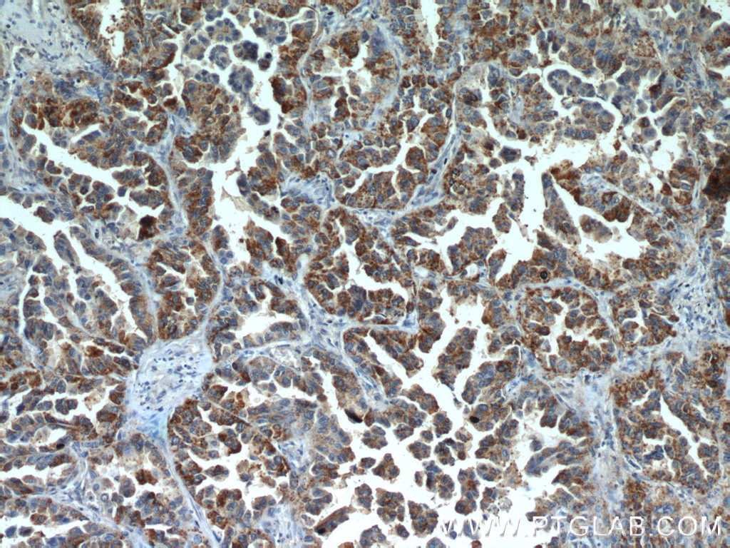 Immunohistochemistry (IHC) staining of human lung cancer tissue using MX1 Polyclonal antibody (13750-1-AP)