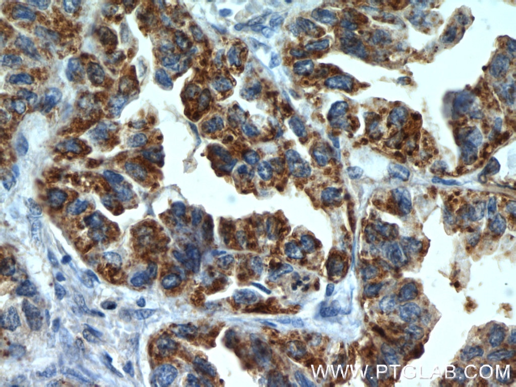 Immunohistochemistry (IHC) staining of human lung cancer tissue using MX1 Polyclonal antibody (13750-1-AP)