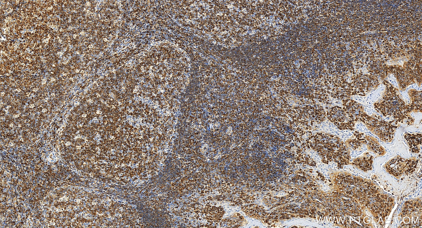 Immunohistochemistry (IHC) staining of human tonsillitis tissue using MX1 Polyclonal antibody (13750-1-AP)