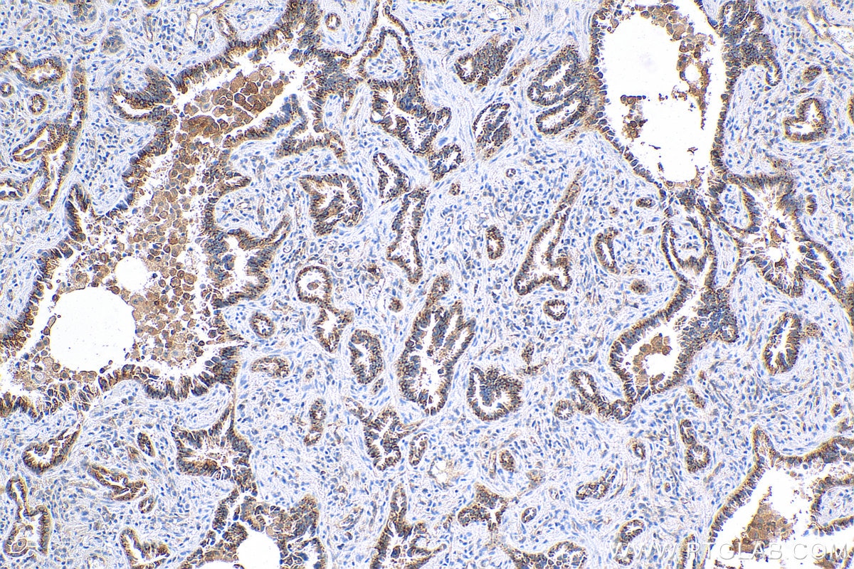 Immunohistochemistry (IHC) staining of human lung cancer tissue using MX1 Recombinant antibody (82677-1-RR)