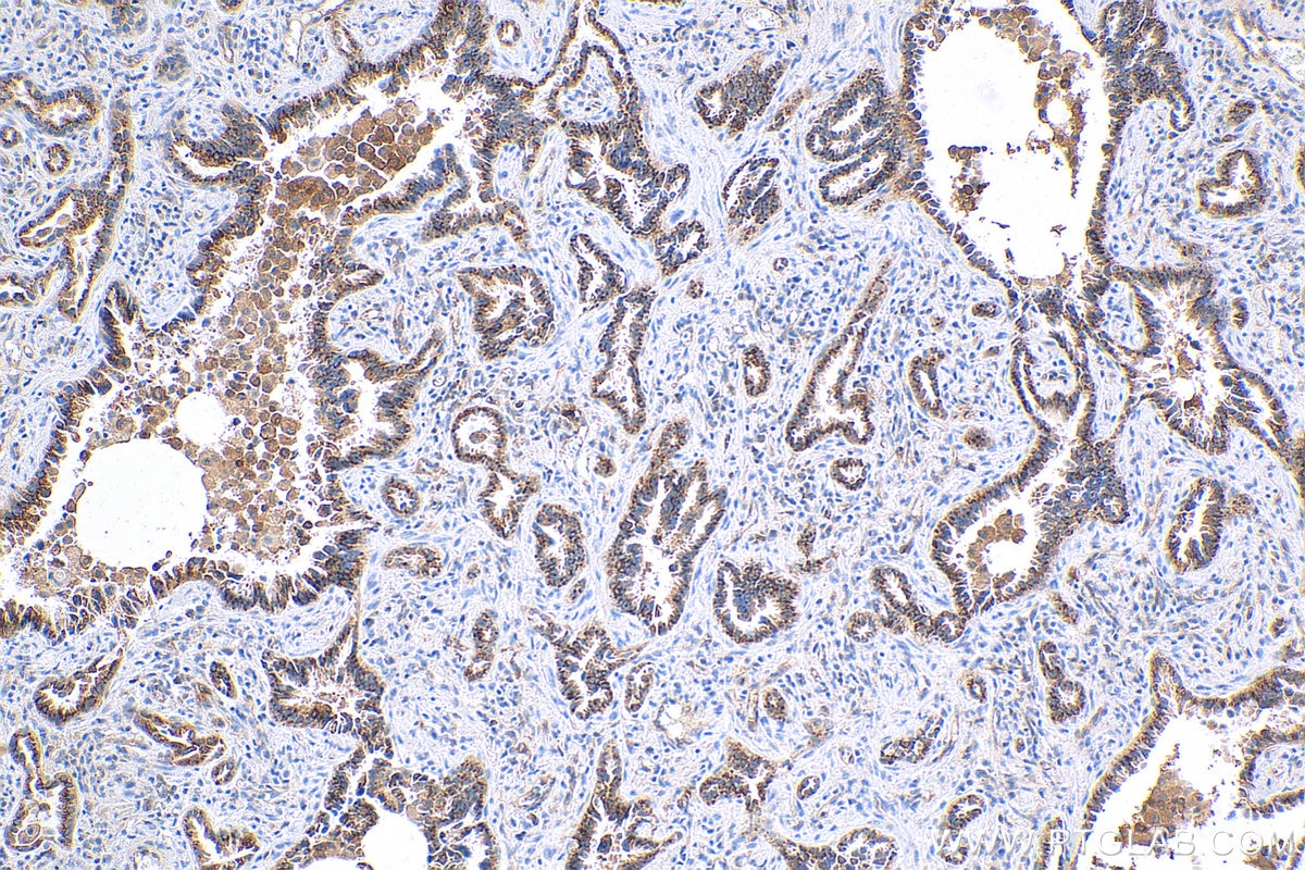 IHC staining of human lung cancer using 82677-1-RR