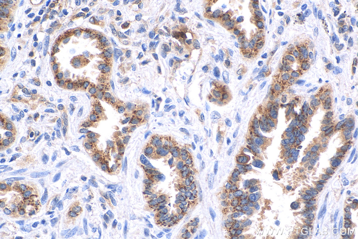 IHC staining of human lung cancer using 82677-1-RR