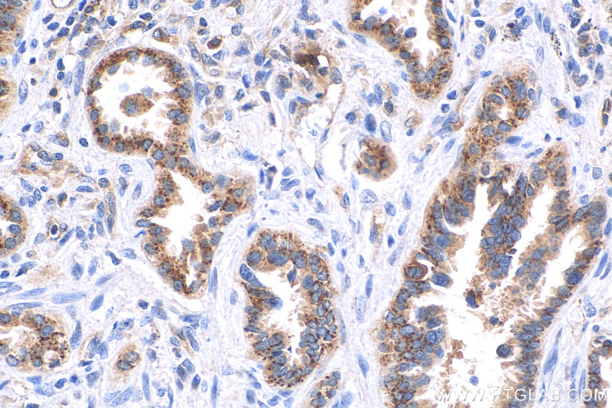 Immunohistochemistry (IHC) staining of human lung cancer tissue using MX1 Recombinant antibody (82677-1-RR)