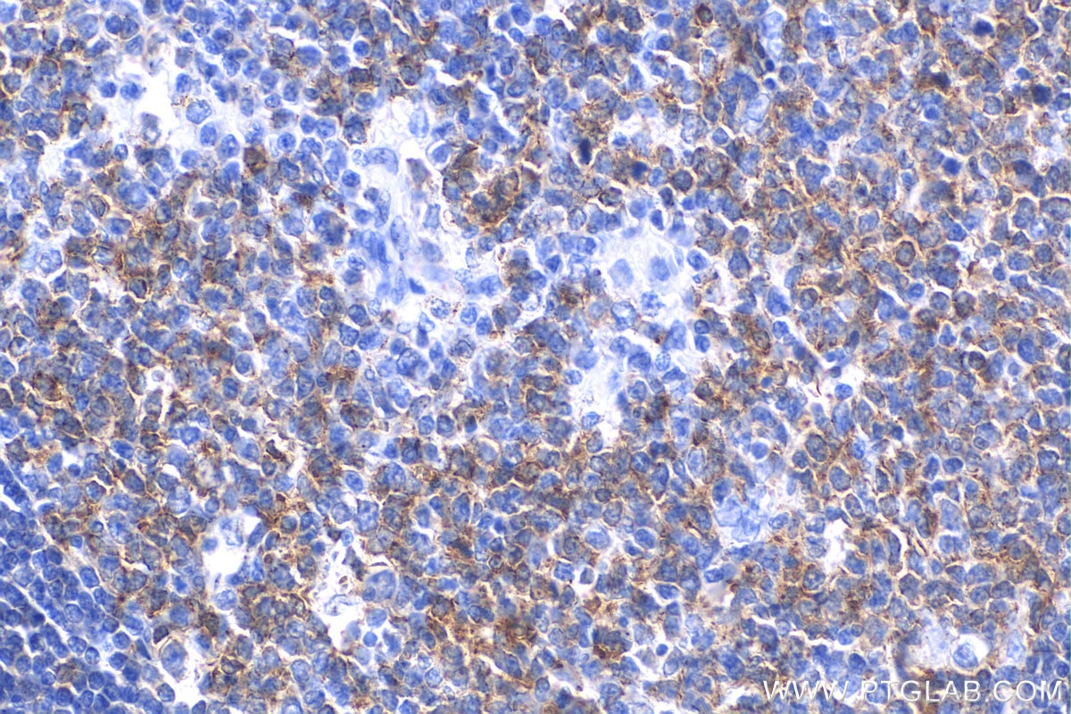 Immunohistochemistry (IHC) staining of human tonsillitis tissue using MX1 Recombinant antibody (82677-1-RR)