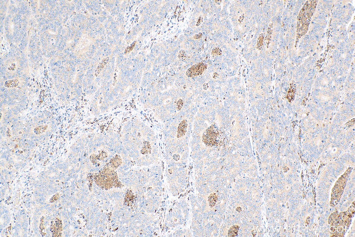 Immunohistochemistry (IHC) staining of human colon cancer tissue using MXRA5 Polyclonal antibody (25472-1-AP)