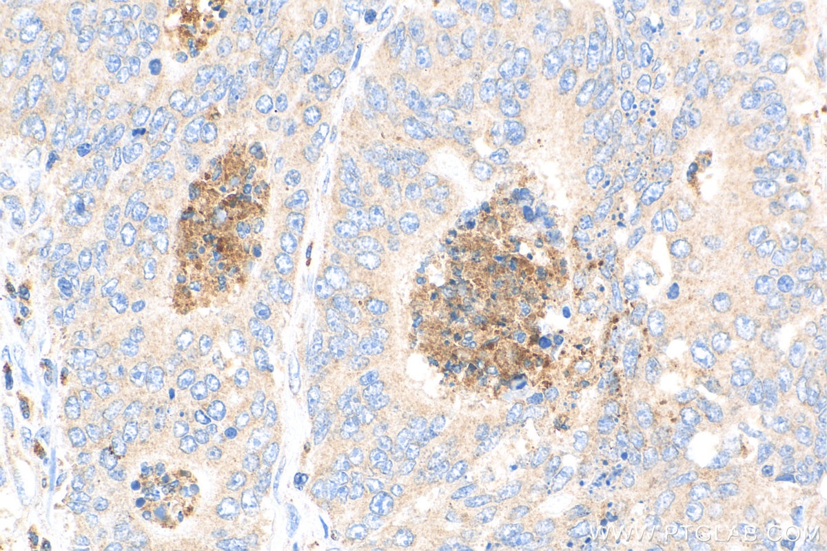 Immunohistochemistry (IHC) staining of human colon cancer tissue using MXRA5 Polyclonal antibody (25472-1-AP)