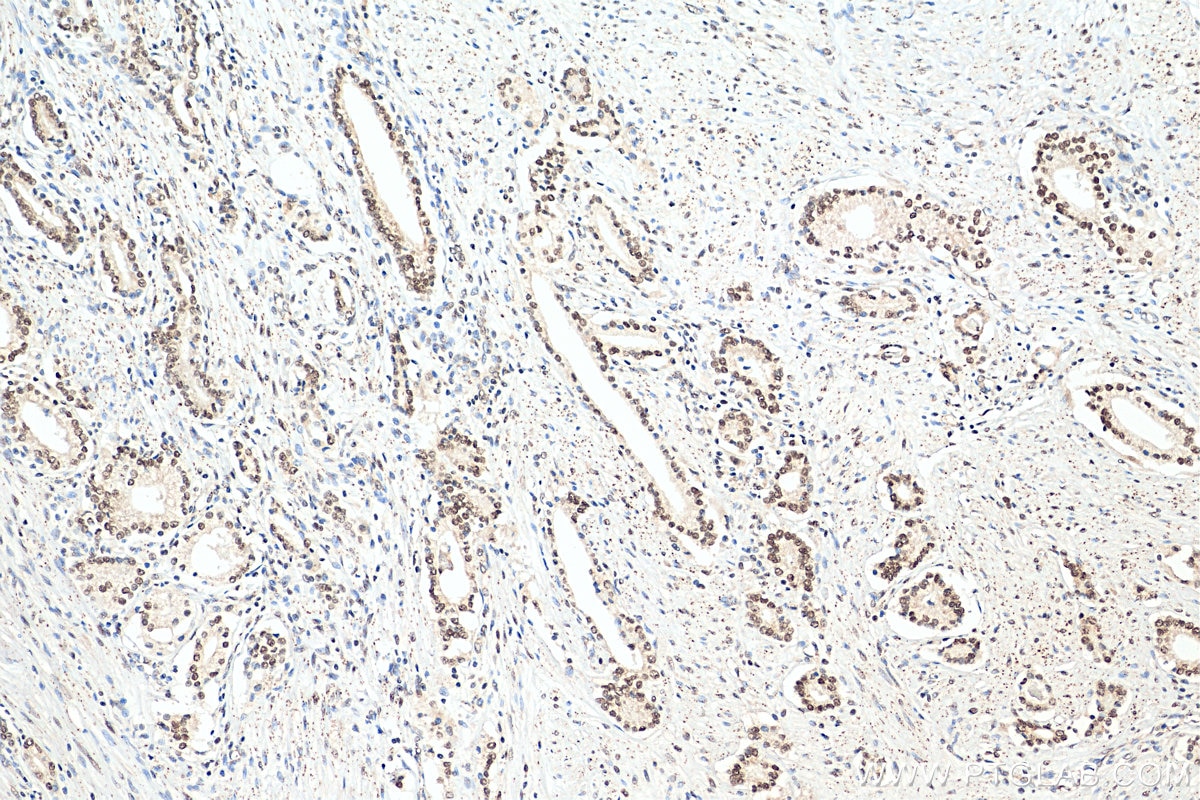 Immunohistochemistry (IHC) staining of human prostate cancer tissue using B-Myb Polyclonal antibody (18896-1-AP)