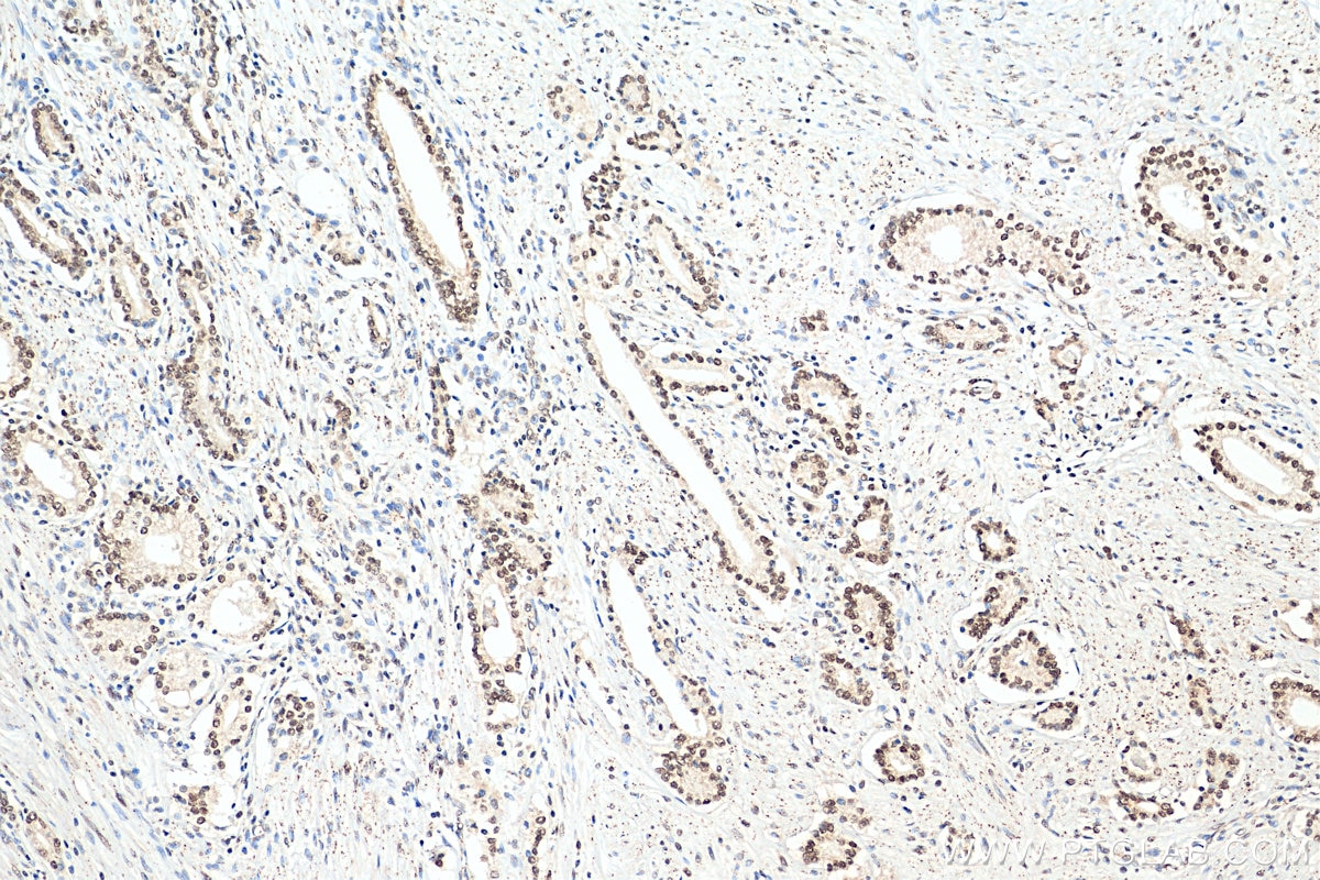 IHC staining of human prostate cancer using 18896-1-AP