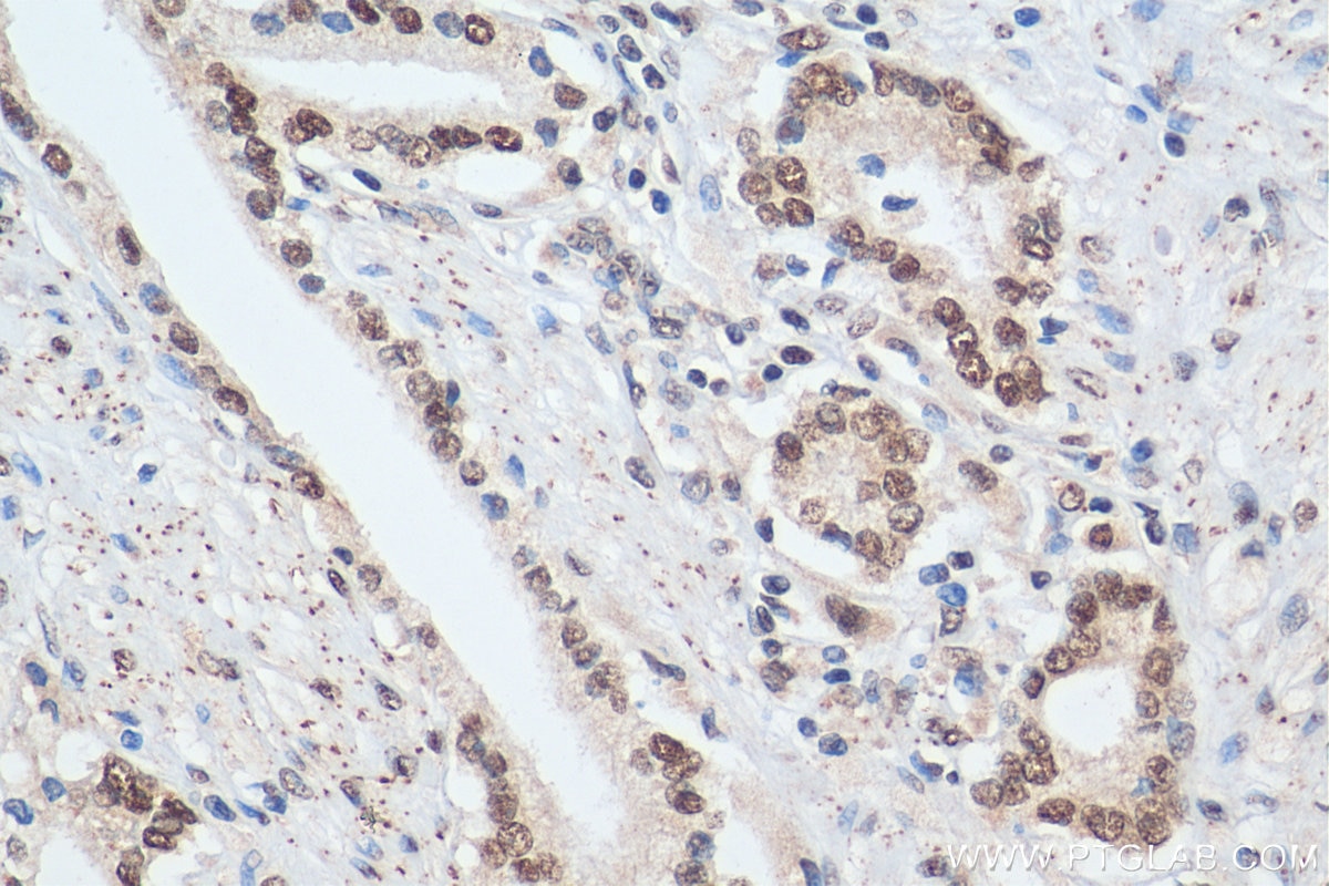 IHC staining of human prostate cancer using 18896-1-AP