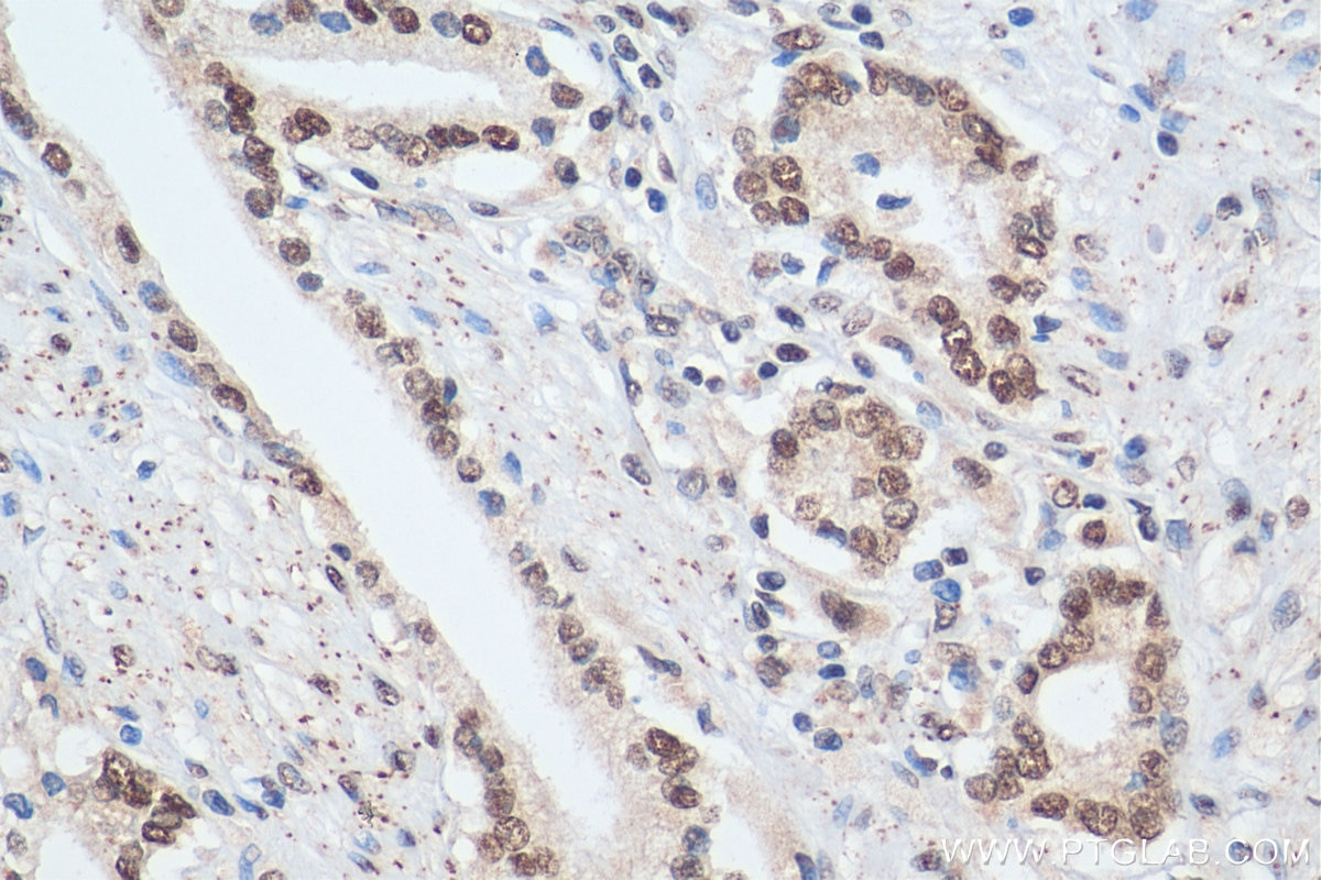 Immunohistochemistry (IHC) staining of human prostate cancer tissue using B-Myb Polyclonal antibody (18896-1-AP)