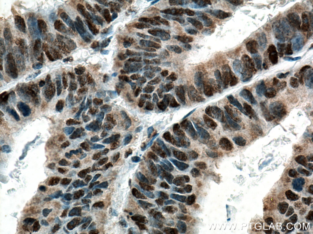 Immunohistochemistry (IHC) staining of human colon cancer tissue using c-MYC Monoclonal antibody (67447-1-Ig)