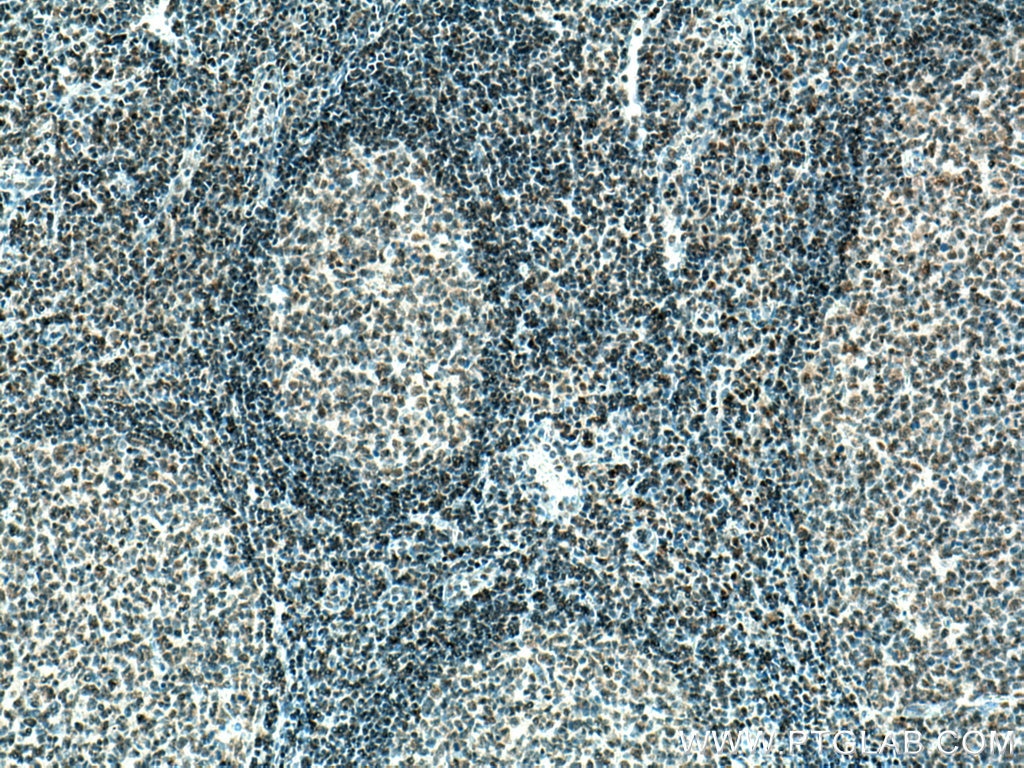 IHC staining of human tonsillitis using 67447-1-Ig