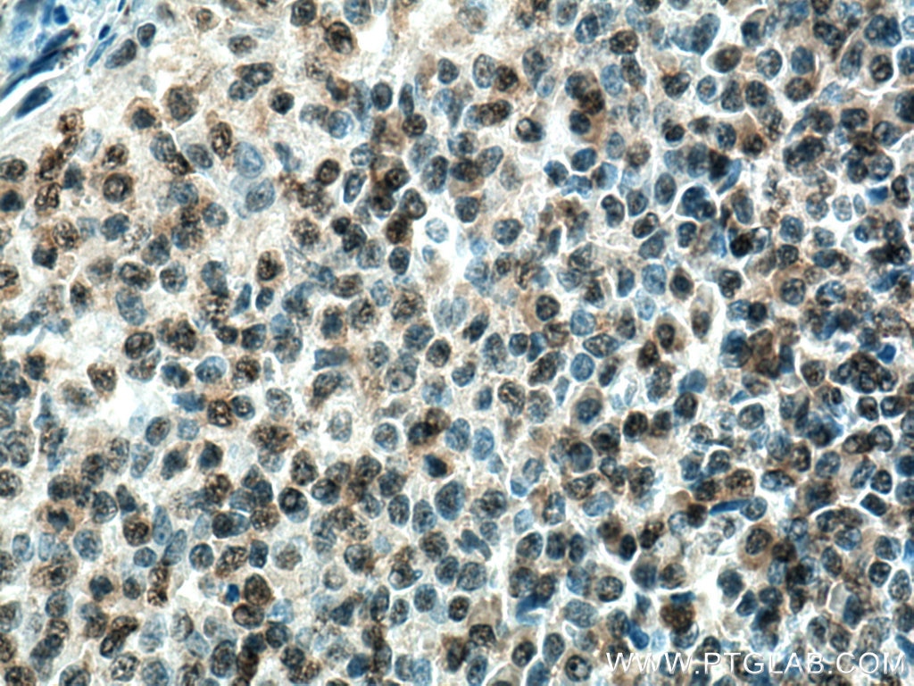 Immunohistochemistry (IHC) staining of human tonsillitis tissue using c-MYC Monoclonal antibody (67447-1-Ig)