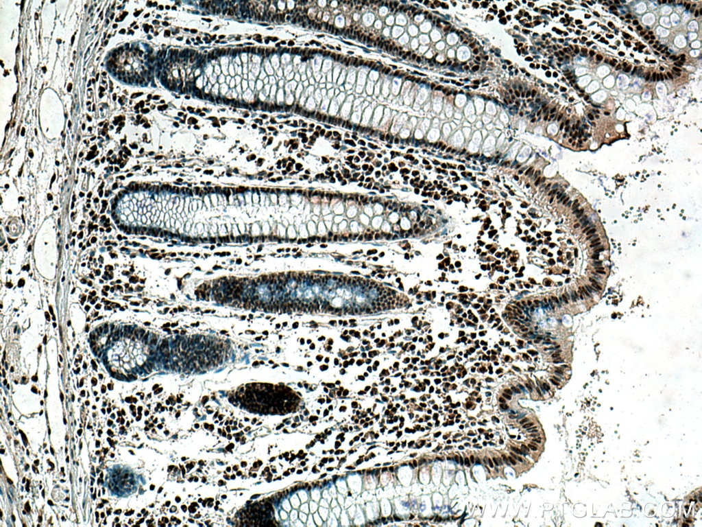 IHC staining of human colon cancer using 67447-1-Ig