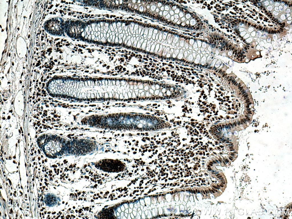 Immunohistochemistry (IHC) staining of human colon cancer tissue using c-MYC Monoclonal antibody (67447-1-Ig)