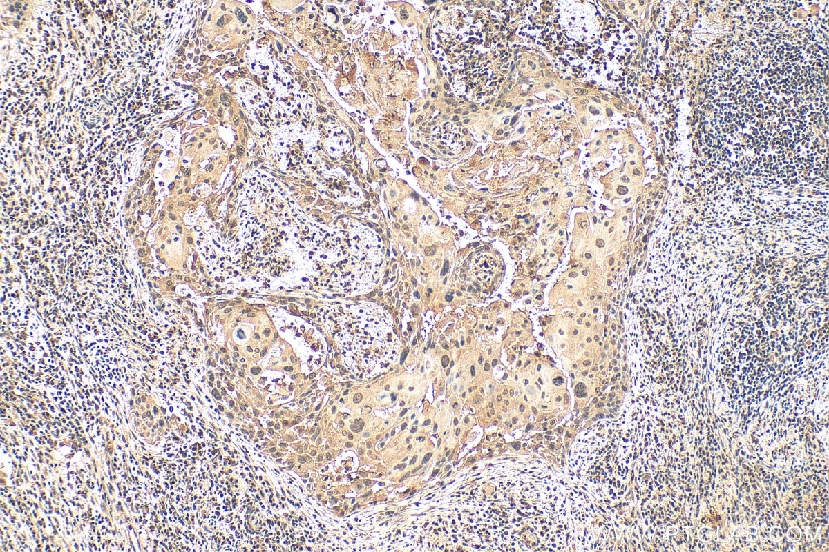 Immunohistochemistry (IHC) staining of human cervical cancer tissue using c-MYC Monoclonal antibody (67447-1-Ig)