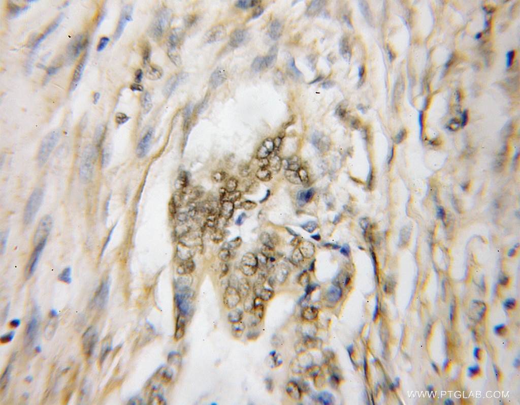 Immunohistochemistry (IHC) staining of human pancreas cancer tissue using MYCBP Polyclonal antibody (12022-1-AP)