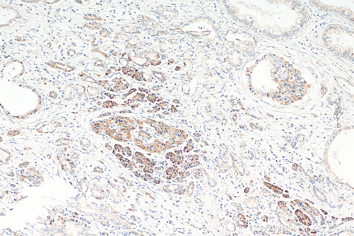 Immunohistochemistry (IHC) staining of human pancreas cancer tissue using MYCBPAP Polyclonal antibody (12763-1-AP)