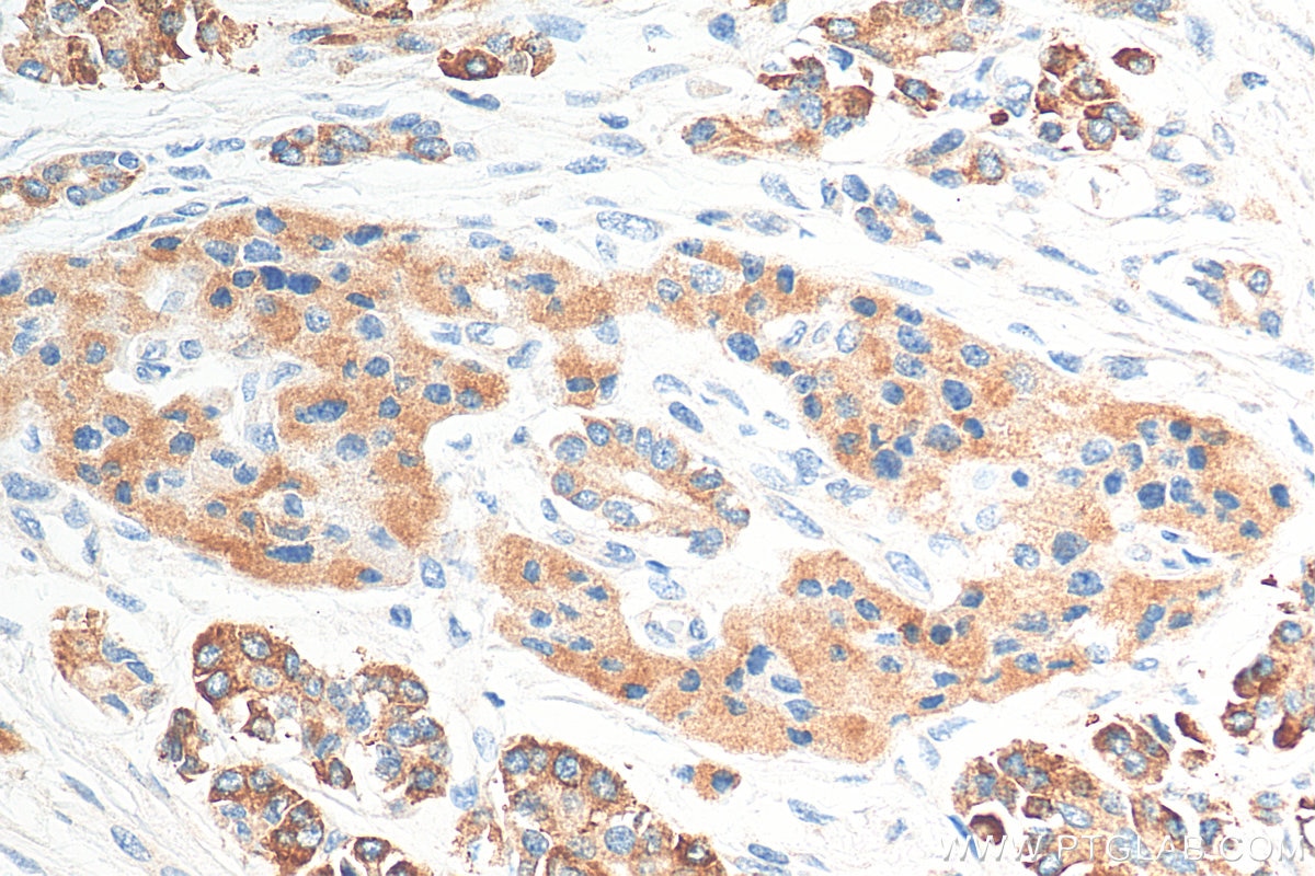 Immunohistochemistry (IHC) staining of human pancreas cancer tissue using MYCBPAP Polyclonal antibody (12763-1-AP)