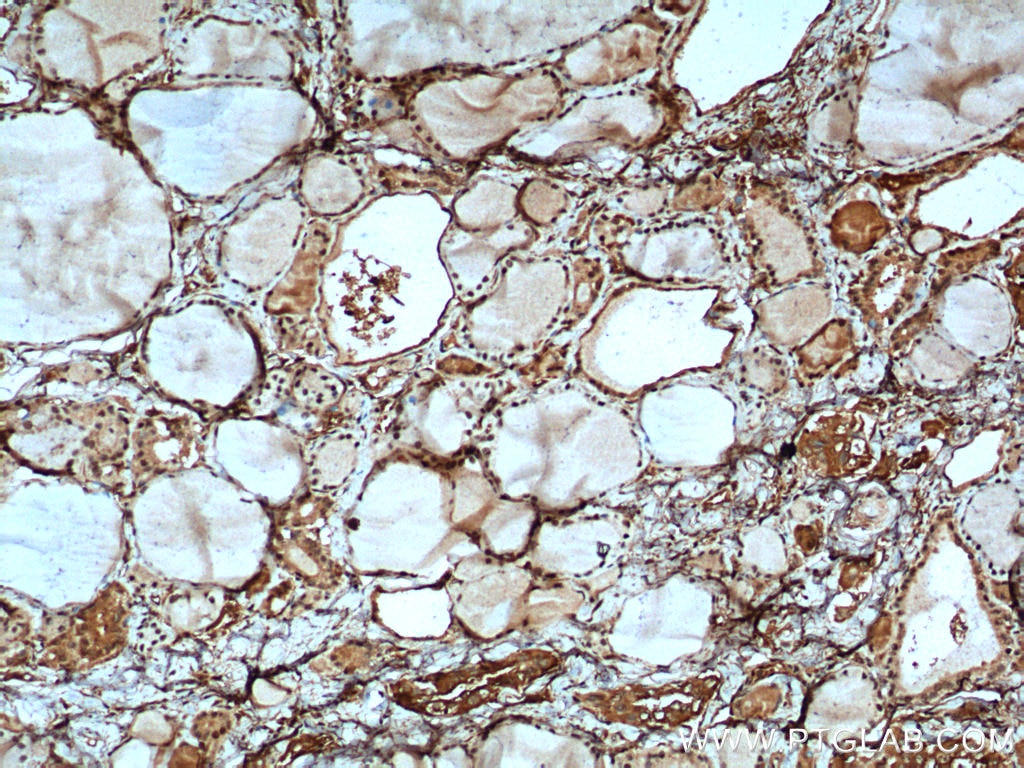 Immunohistochemistry (IHC) staining of human thyroid cancer tissue using MYCN Polyclonal antibody (10159-2-AP)
