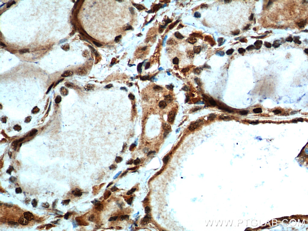 Immunohistochemistry (IHC) staining of human thyroid cancer tissue using MYCN Polyclonal antibody (10159-2-AP)