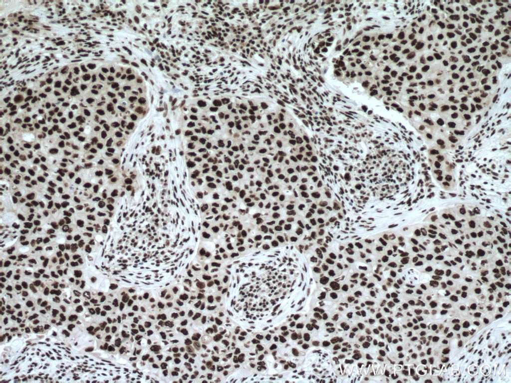 Immunohistochemistry (IHC) staining of human breast cancer tissue using MYEF2 Polyclonal antibody (16051-1-AP)