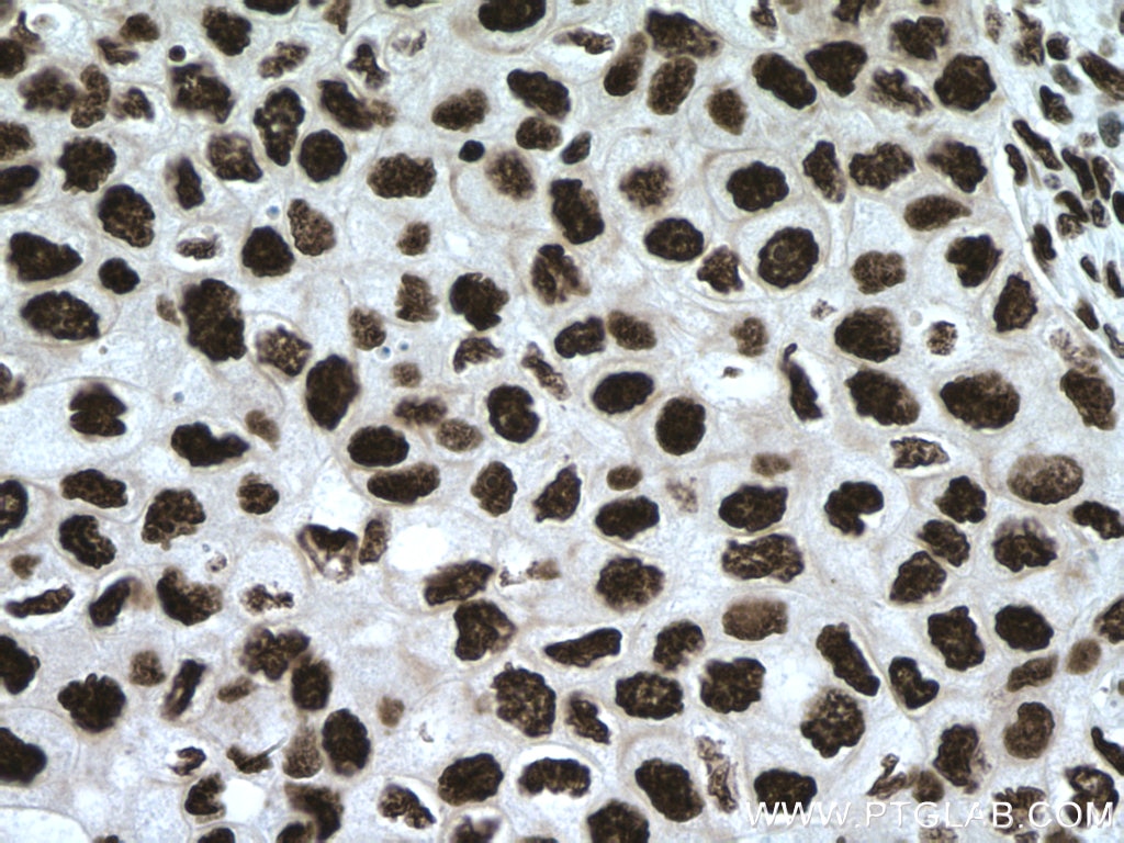 Immunohistochemistry (IHC) staining of human breast cancer tissue using MYEF2 Polyclonal antibody (16051-1-AP)