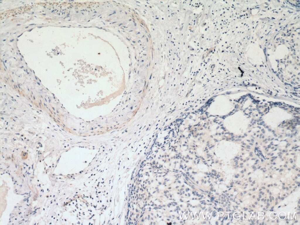 Immunohistochemistry (IHC) staining of human breast hyperplasia tissue using SMMHC Monoclonal antibody (60222-1-Ig)