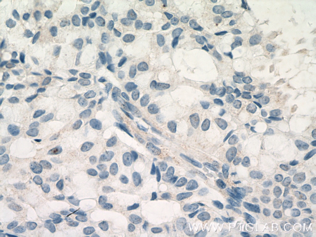 Immunohistochemistry (IHC) staining of human breast hyperplasia tissue using SMMHC Monoclonal antibody (60222-1-Ig)