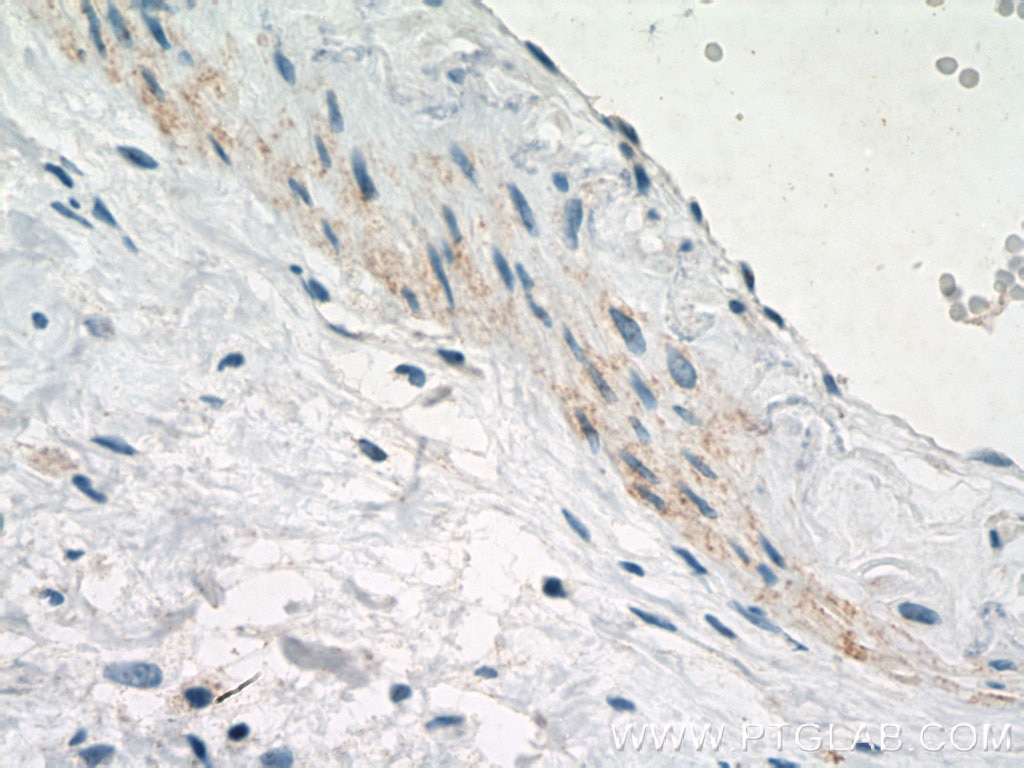 Immunohistochemistry (IHC) staining of human breast hyperplasia tissue using SMMHC Monoclonal antibody (60222-1-Ig)