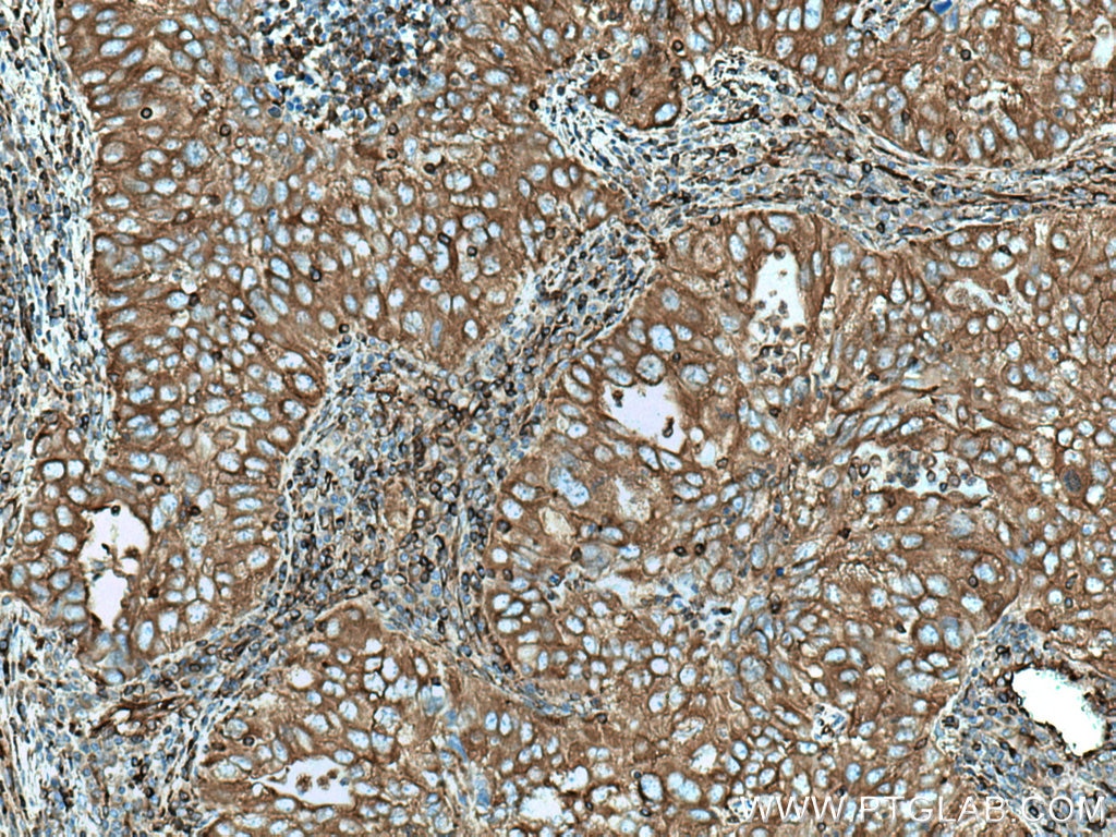 Immunohistochemistry (IHC) staining of human lung cancer tissue using MYH9 Polyclonal antibody (11128-1-AP)