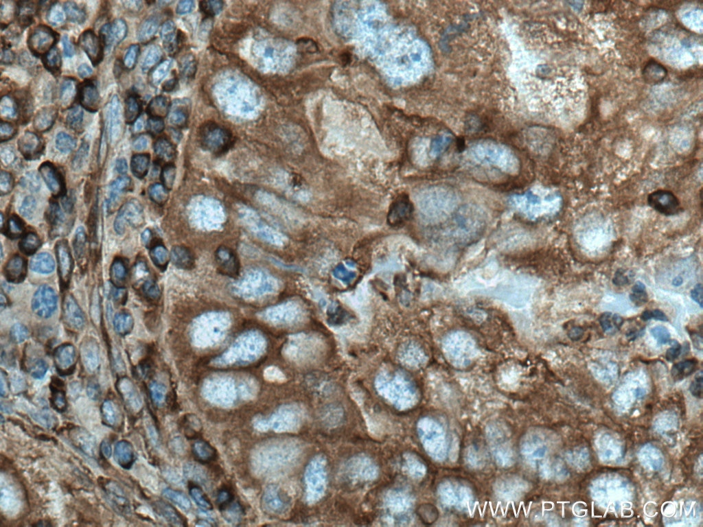 Immunohistochemistry (IHC) staining of human lung cancer tissue using MYH9 Polyclonal antibody (11128-1-AP)