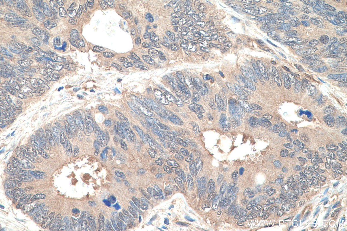 Immunohistochemistry (IHC) staining of human colon cancer tissue using MYH9 Recombinant antibody (81204-1-RR)