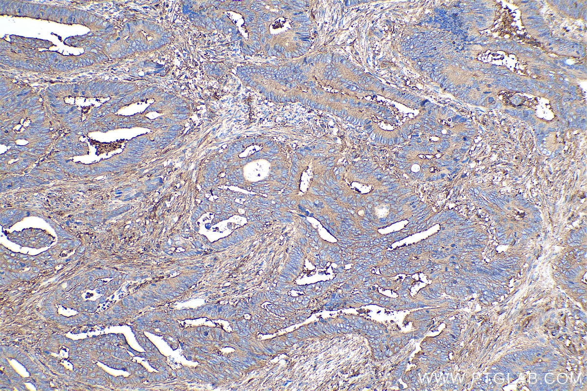 Immunohistochemistry (IHC) staining of human colon cancer tissue using MYL12A Polyclonal antibody (16287-1-AP)