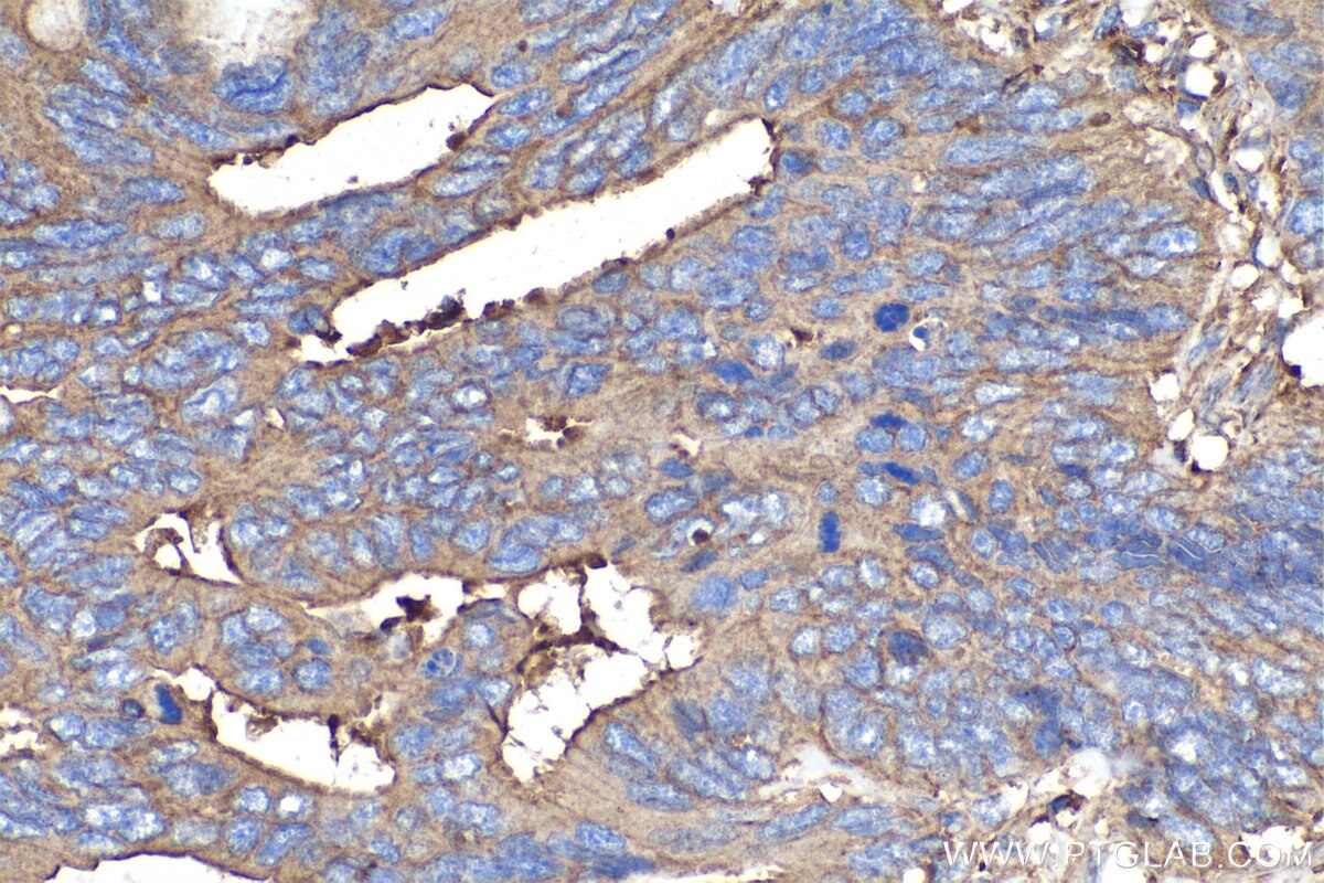 Immunohistochemistry (IHC) staining of human colon cancer tissue using MYL12A Polyclonal antibody (16287-1-AP)