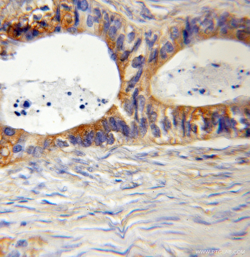 Immunohistochemistry (IHC) staining of human colon cancer tissue using MYL12B Polyclonal antibody (10324-1-AP)