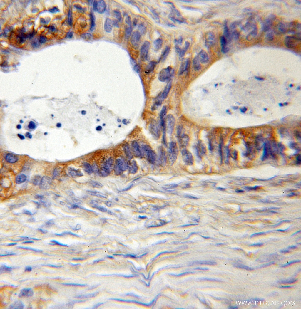 IHC staining of human colon cancer using 10324-1-AP