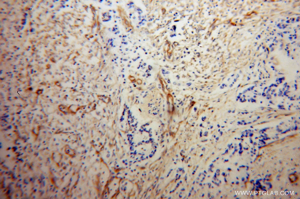 Immunohistochemistry (IHC) staining of human colon cancer tissue using MYL12B Polyclonal antibody (10324-1-AP)