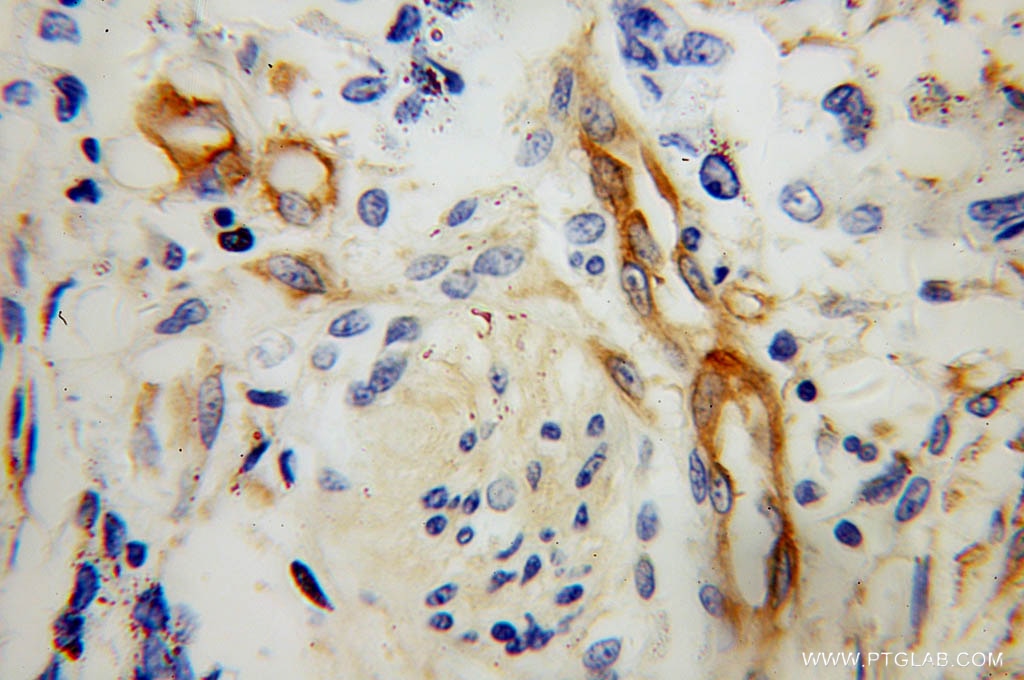 Immunohistochemistry (IHC) staining of human colon cancer tissue using MYL12B Polyclonal antibody (10324-1-AP)