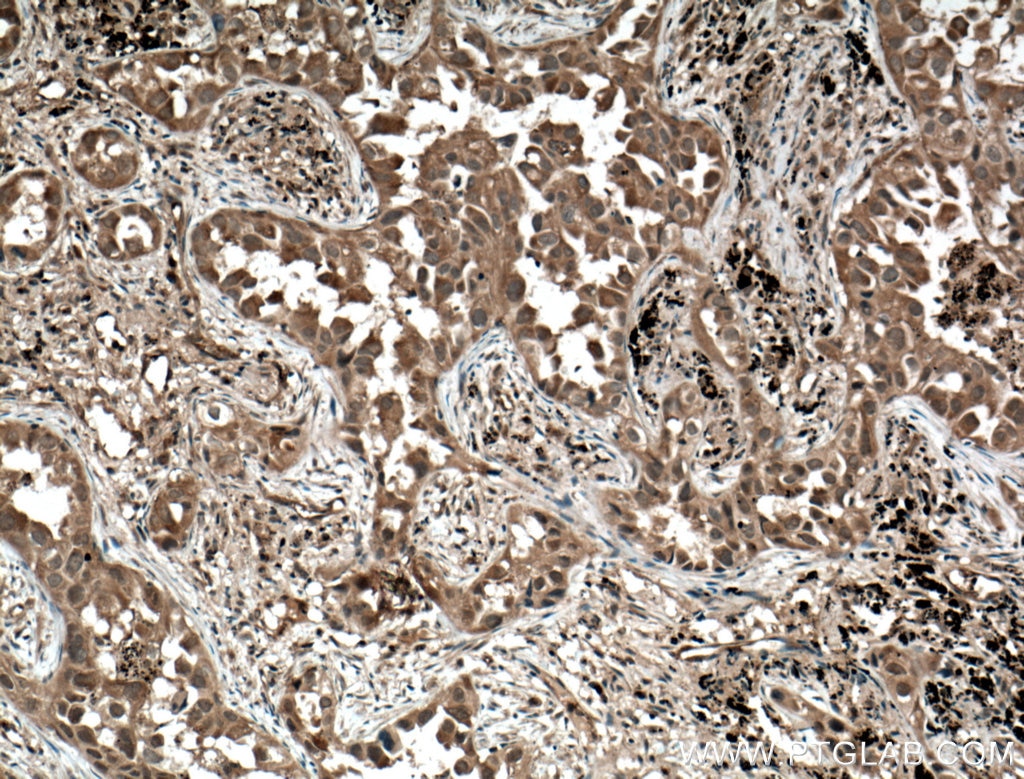 IHC staining of human lung cancer using 10913-1-AP