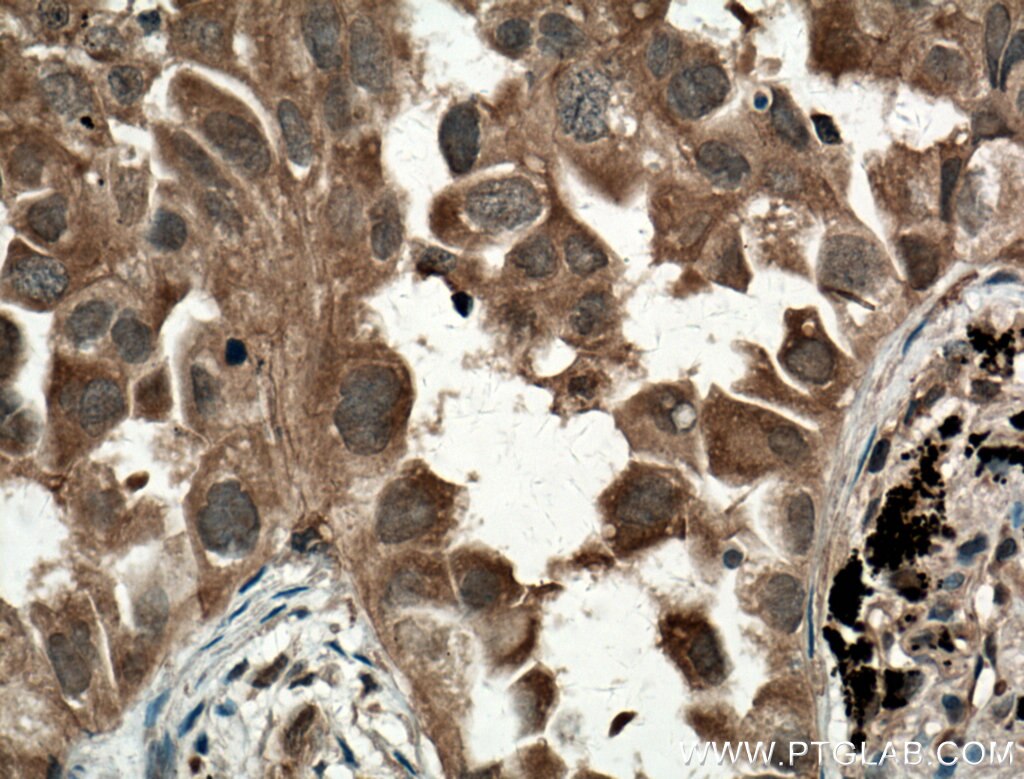 Immunohistochemistry (IHC) staining of human lung cancer tissue using MYL3 Polyclonal antibody (10913-1-AP)