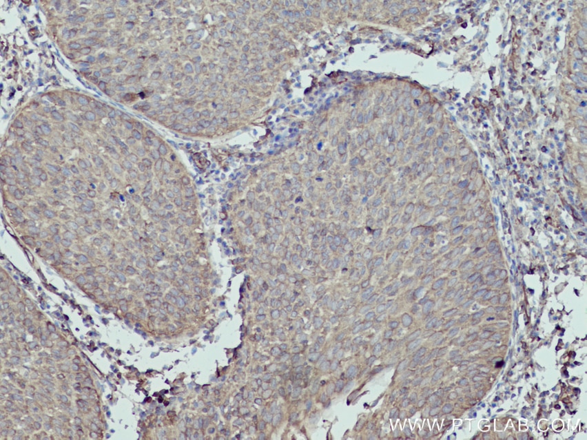 Immunohistochemistry (IHC) staining of human cervical cancer tissue using MYL5 Polyclonal antibody (14249-1-AP)