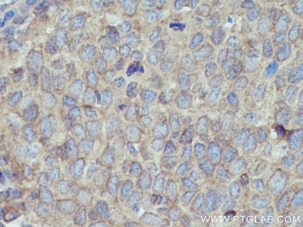 Immunohistochemistry (IHC) staining of human cervical cancer tissue using MYL5 Polyclonal antibody (14249-1-AP)