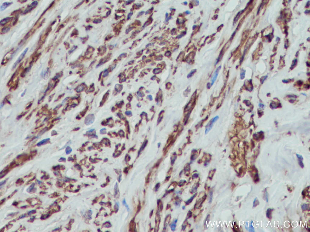 Immunohistochemistry (IHC) staining of human cervical cancer tissue using MYL5 Polyclonal antibody (14249-1-AP)