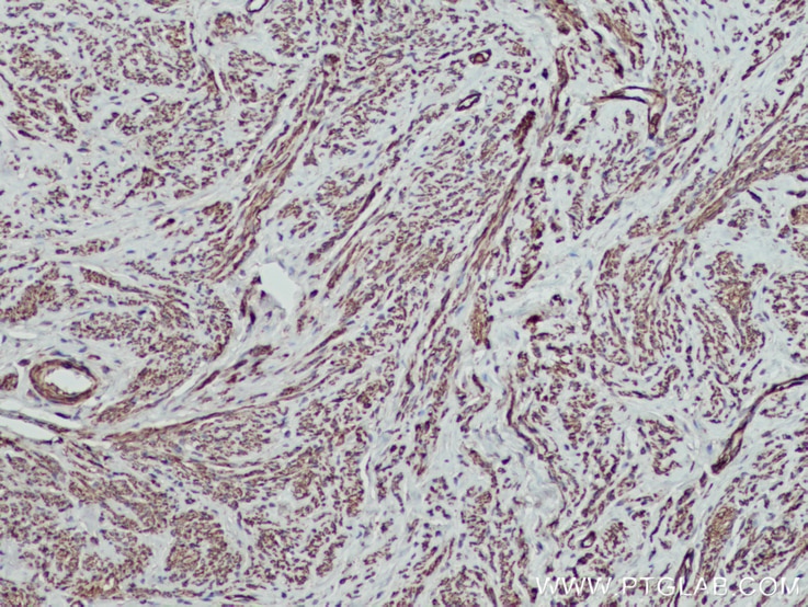 Immunohistochemistry (IHC) staining of human cervical cancer tissue using MYL5 Polyclonal antibody (14249-1-AP)