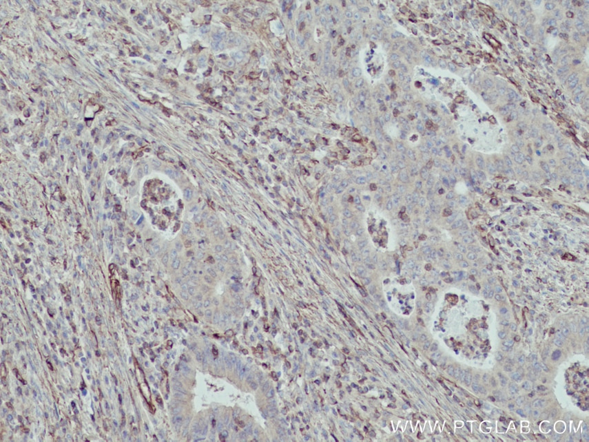 Immunohistochemistry (IHC) staining of human colon cancer tissue using MYL9 Polyclonal antibody (15354-1-AP)