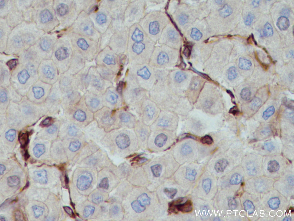 Immunohistochemistry (IHC) staining of human liver cancer tissue using MYL9 Polyclonal antibody (15354-1-AP)